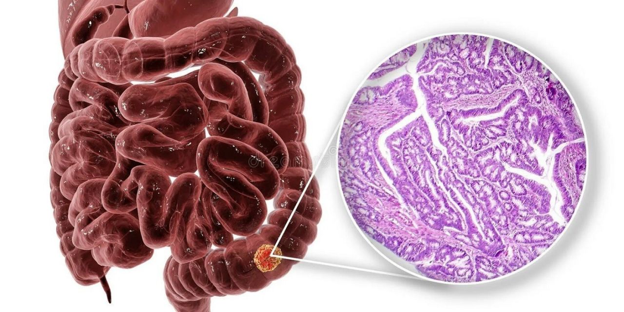 У пациентов с аденокарциномой толстой кишки могут возникнуть проблемы со стулом