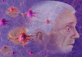 Чем отличается деменция от болезни Альцгеймера?