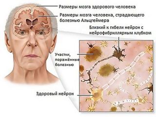 Болезнь Альцгеймера: причины, симптомы, диагностика и лечение