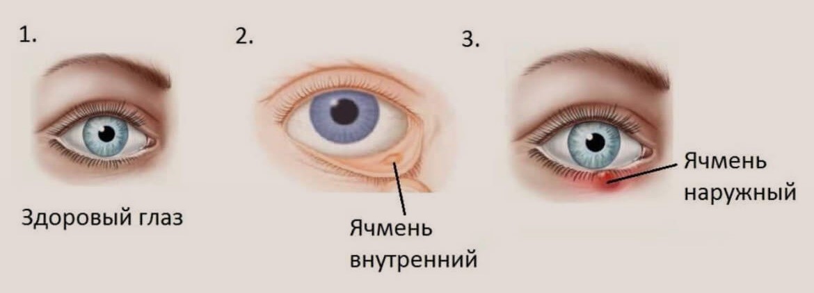 Часто ячмень. Ячмень стадии развития глазной. Этапы развития ячменя на глазу. Как выглядит ячмень на глазу как лечить. Воспаление внутри Нижнего века глаза.