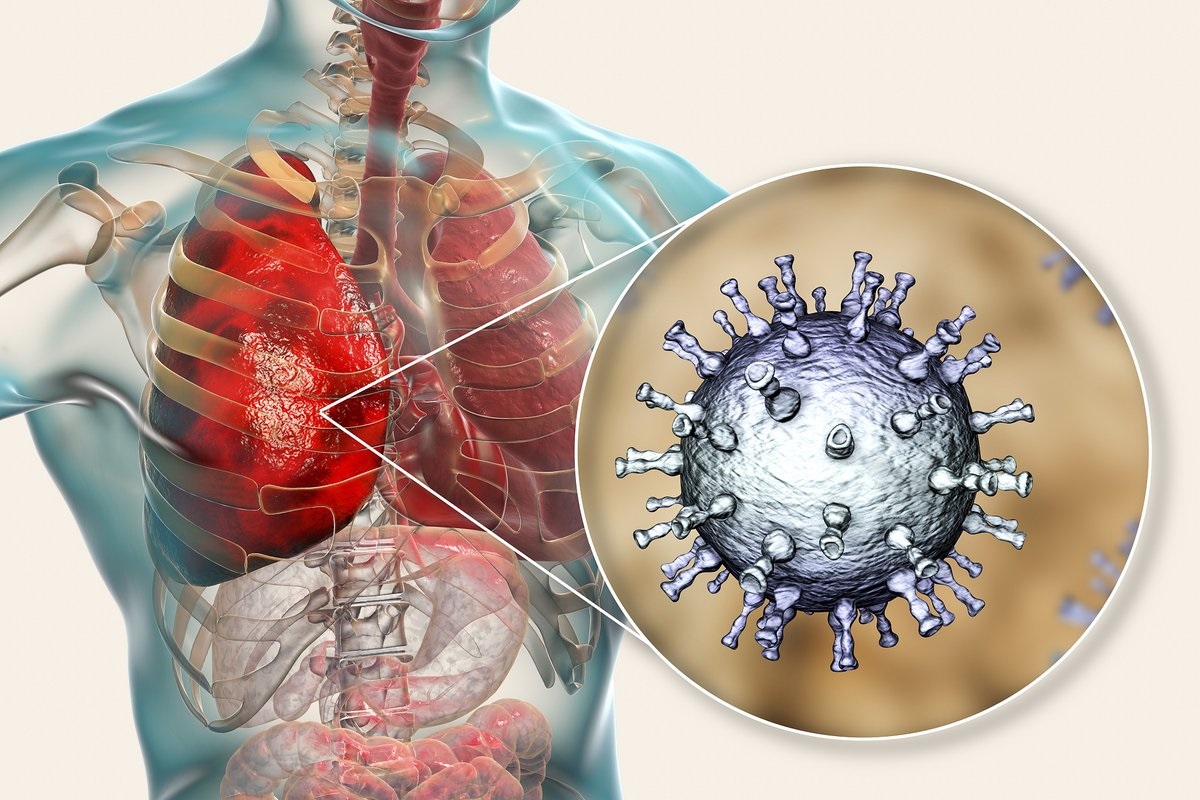 Вирус пневмонии картинки