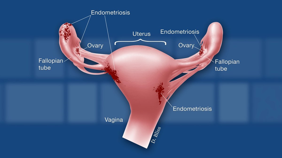 Endometriosis abdominal síntomas