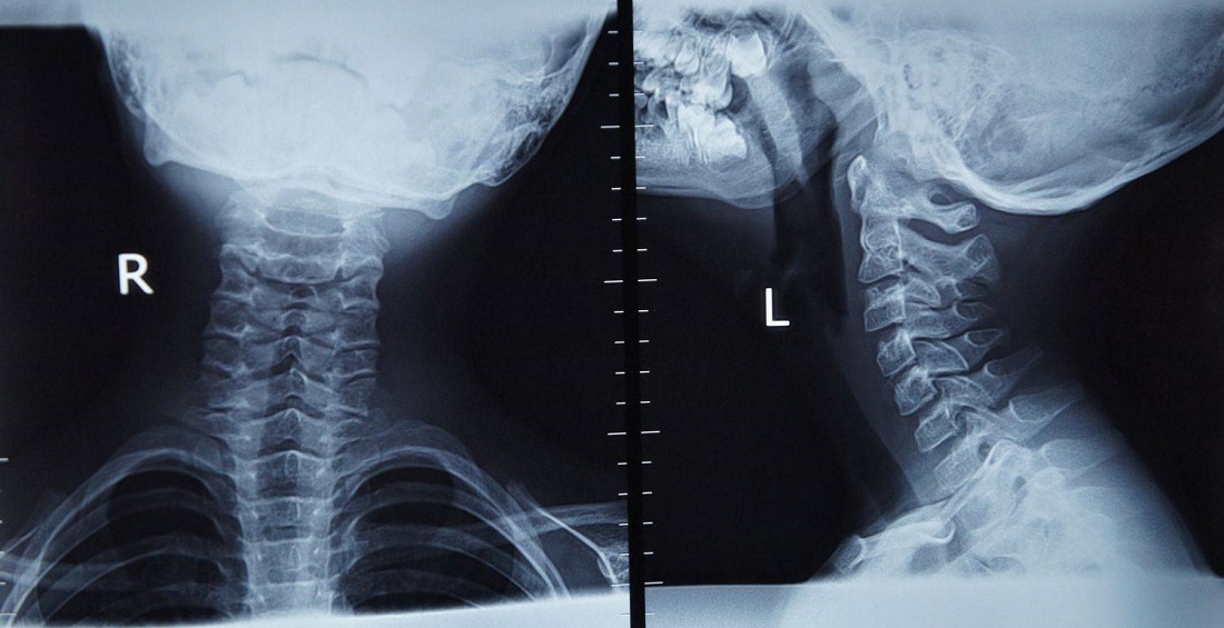 Рентген шейного. Рентген шейного отдела норма. Рентген шейного отдела позвоночника. Вывих шеи рентген. Синдром короткого позвоночника.
