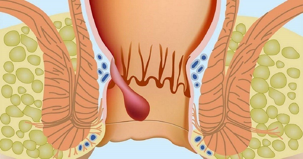 Врачи рассказали, как избавиться от анальной трещины