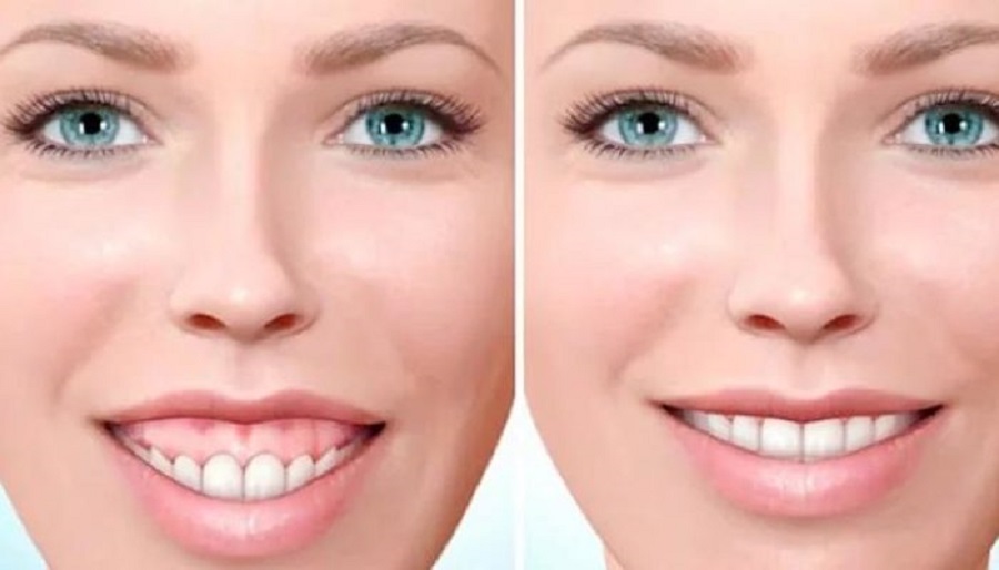 Коррекция улыбки ботоксом фото до и после